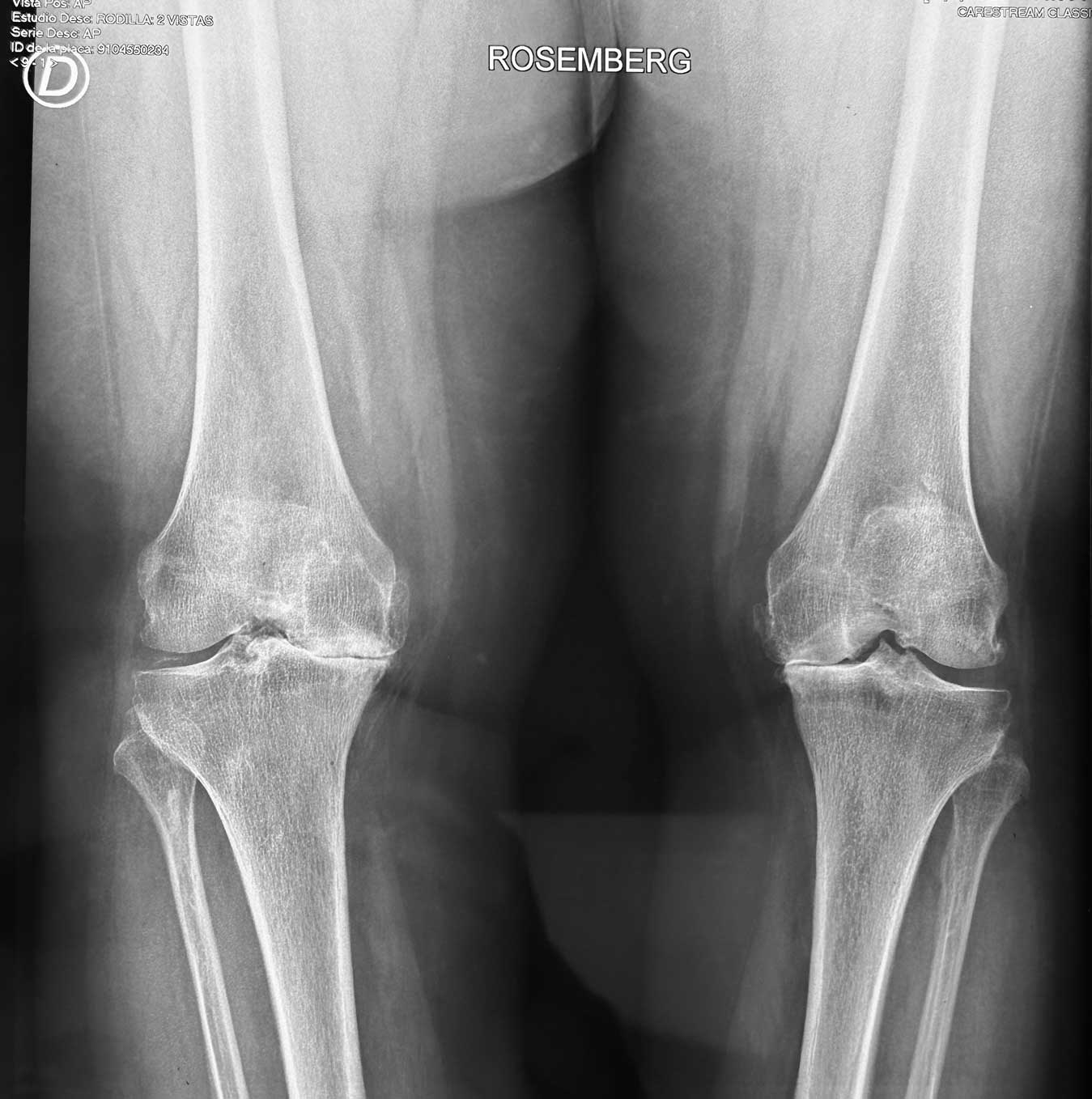 RADIOGRAFIA-ARTROSIS-SEVERA-RODILLA