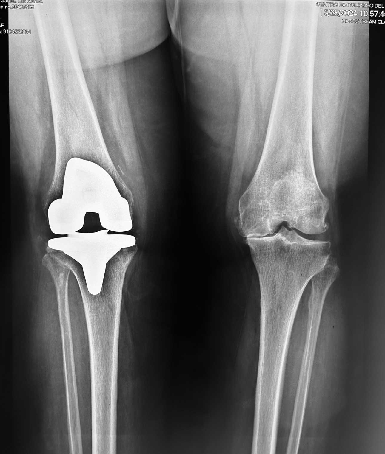 RADIOGRAFIA-CON-PROTESIS-DE-RODILLA